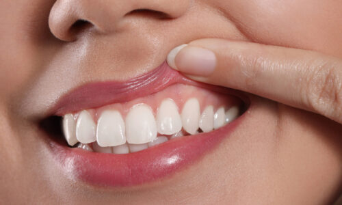 Frau zieht mit ihrem Finger ihre Lippe hoch, damit das Zahnfleisch sichtbar wird.