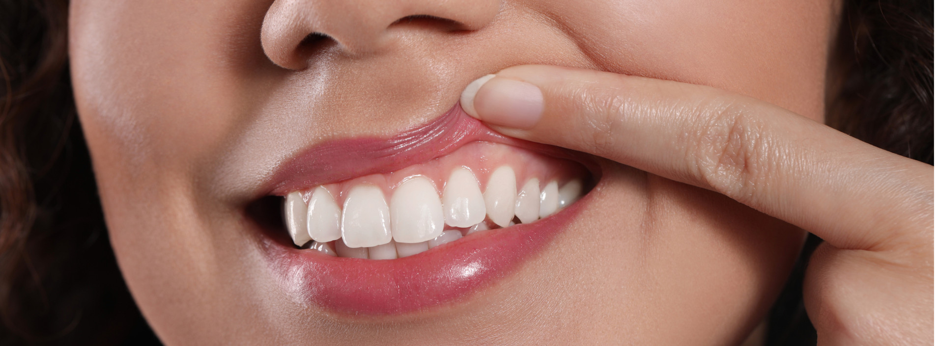 Frau zieht mit ihrem Finger ihre Lippe hoch, damit das Zahnfleisch sichtbar wird.