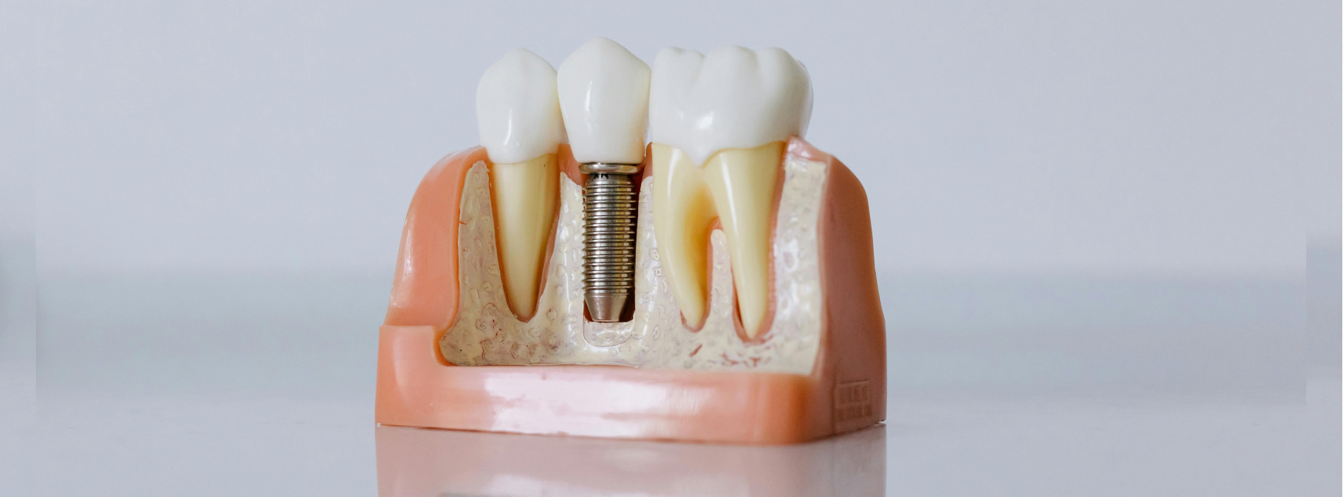 Ein Zahnmodell im Anschnitt zeigt neben einer Zahnwurzel wie ein Zahnimplantat im Kieferknochen verankert ist.